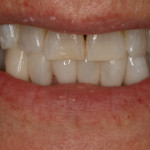 Composite Fillings Before and After | Stockton CA