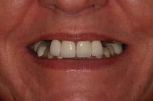 partial dentures before patient photo 