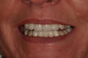 partial dentures after patient photo