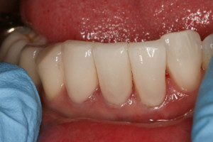 Dental Bonding Before and After | Stockton, CA