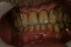 Dentures in Stockton CA