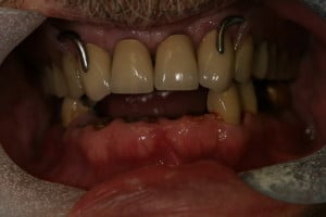 Dentures in Stockton CA