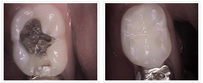 composite fillings before and after 