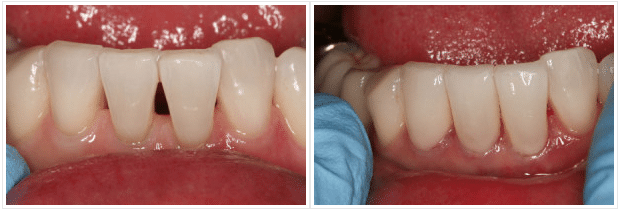 dental bonding before & after photo stockton ca - deer park dental 