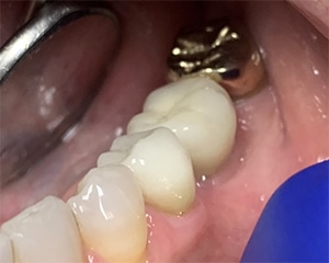 dental implants after