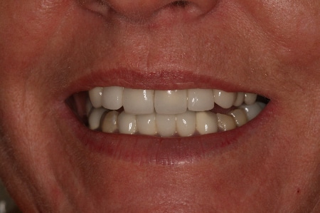 partial dentures after