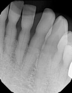 Front Tooth Fracture