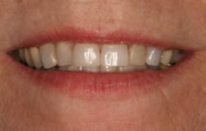 Teeth Whitening, Porcelain Crowns